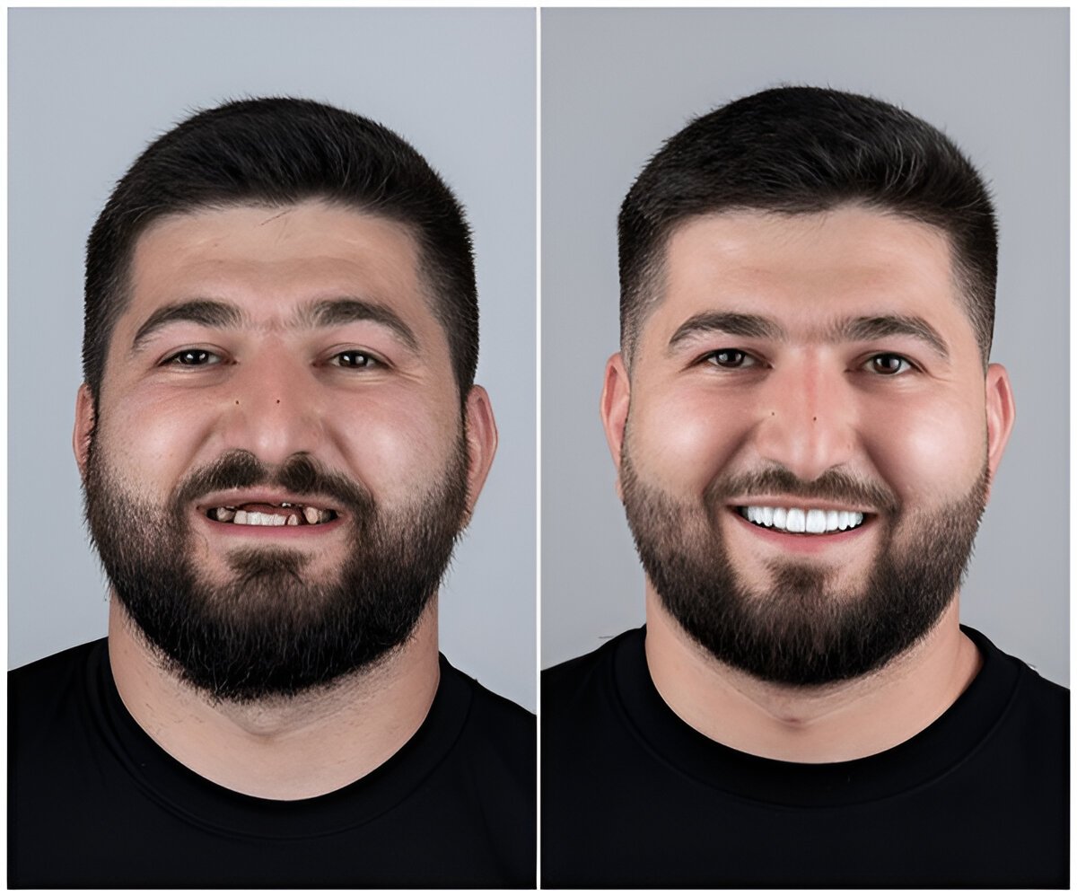 Advanced Dental Implants in Fort Saskatchewan