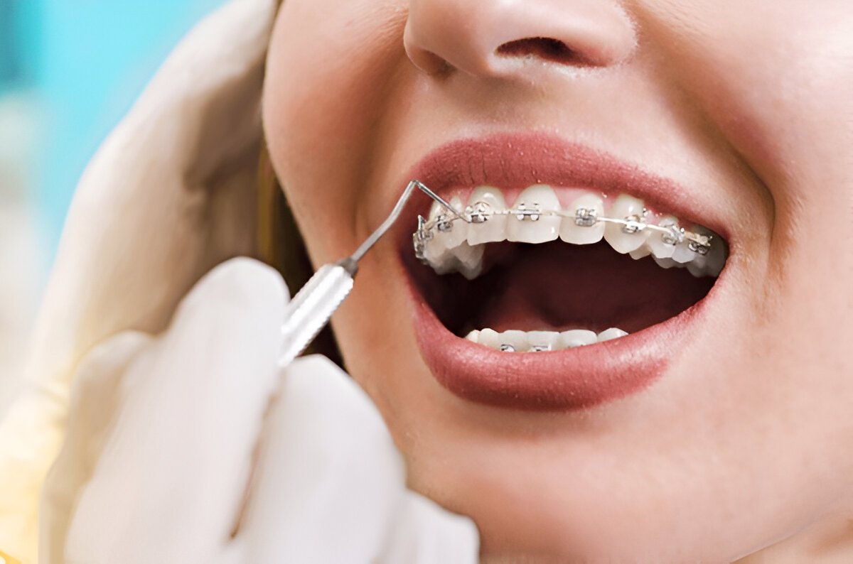 Orthodontics – Fort Saskatchewan